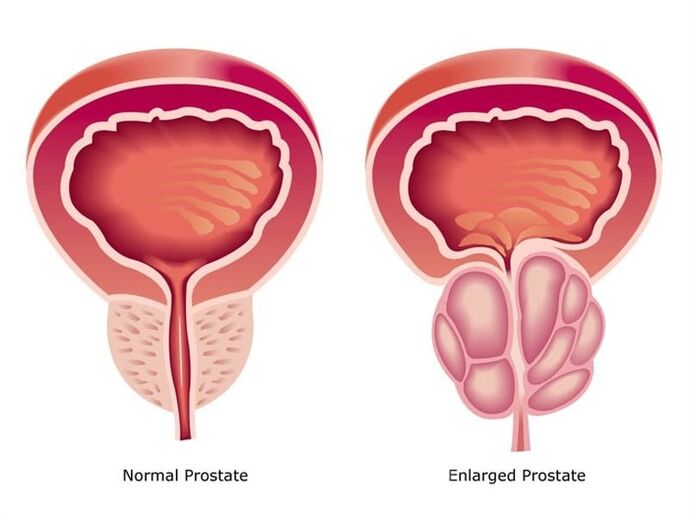 Prostovit normalizē prostatas darbu un izmēru