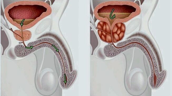 vesela un iekaisusi prostata ar prostatītu
