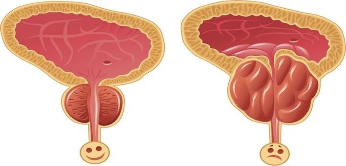 vesela un iekaisusi prostata