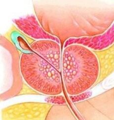 Prostatas adenoma