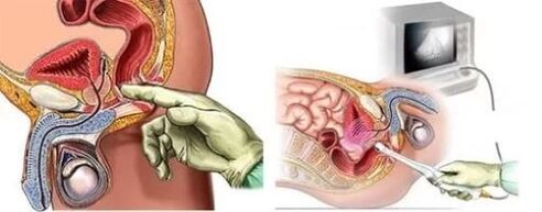 Prostatīta instrumentālā diagnoze