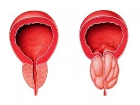 Veselīga un iekaista prostata